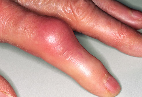gout on hand